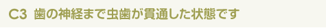 C3 歯の神経まで虫歯が貫通した状態です