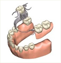 部分入れ歯